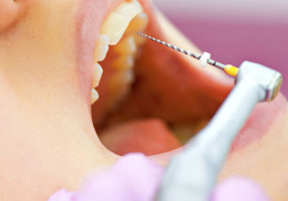 Root Canal Treatment