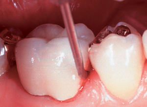 Gum Bleeding Treatment