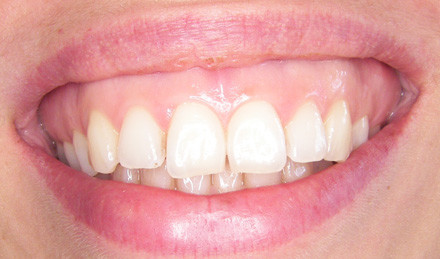 Gum Surgery
