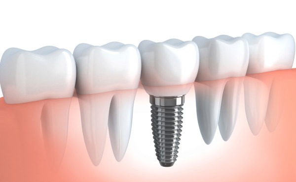 Implant